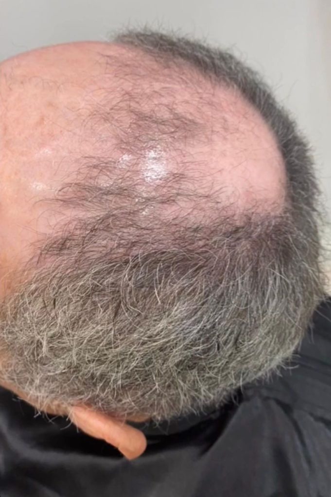 prothese-capillaire-avant-homme-faceaface-perruques-medicales-mc-coiffure-salon-estavayer-fribourg-suisse