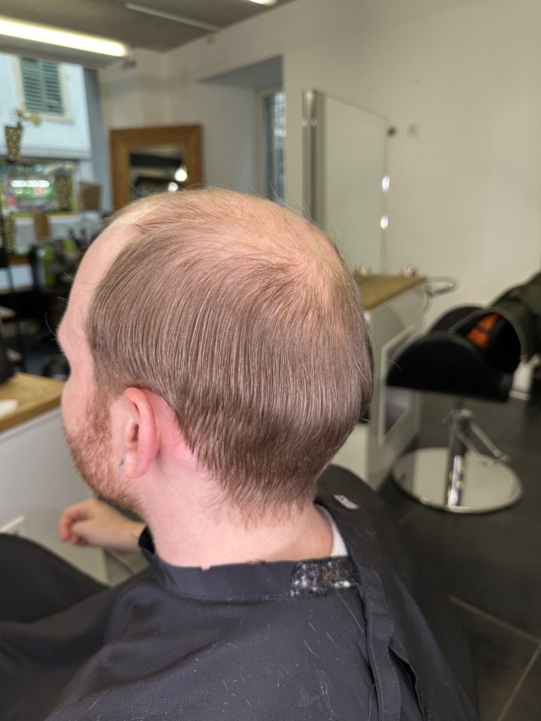 prothese-capillaire-avant-homme-faceaface-perruques-medicales-mc-coiffure-salon-estavayer-fribourg-suisse